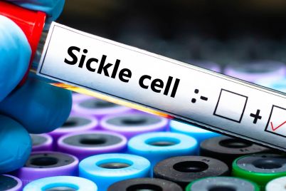 new-sickle-cell-gene-therapies-are-a-breakthrough-but-solving-how-to-pay-their-high-prices-is-a-struggle-scaled.jpg
