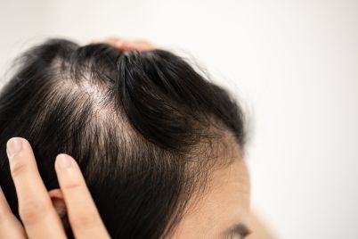 weight-loss-and-hair-loss-the-growing-hair-treatment-market-from-glp-1s.jpg
