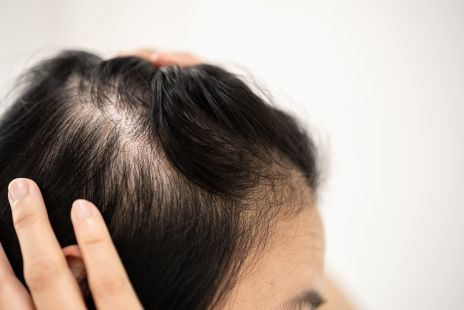 weight-loss-and-hair-loss-the-growing-hair-treatment-market-from-glp-1s.jpg